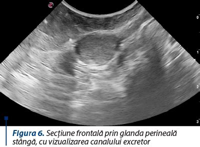 Ilustrație schematică a anatomiei perianale, cu evidențierea glandelor anale și a posibilei formări a unei fistule.