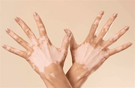 Imagine cu o persoană care prezintă pete de vitiligo pe piele, ilustrând pierderea pigmentului.