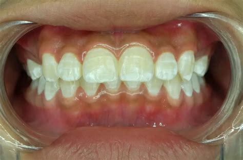 Ilustrație comparativă: pete albe pe dinți (demineralizare) vs. pete negre pe dinți (carie)