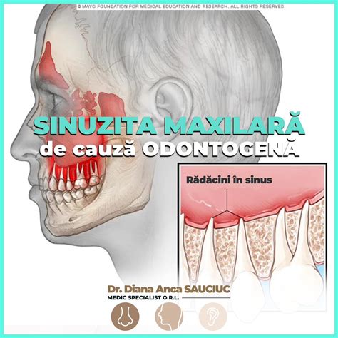 Infografic cu cele mai frecvente afecțiuni dentare în sarcină: gingivită, granulom de sarcină, carii