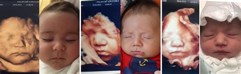 Fotografie cu o ecografie 3D a unui bebeluș în uter.