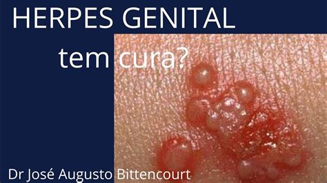 Ilustrație medicală cu localizarea veziculelor de herpes genital la bărbați și femei.