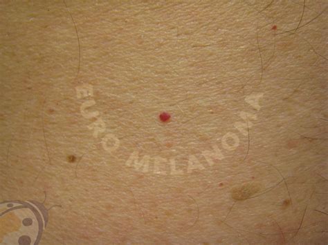 Ilustrație cu diferite tipuri de semne din naștere: pete materne, angiom, pată mongoloidă.