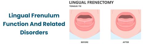 Reprezentare anatomică a frenului lingual normal și restrictiv