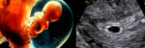 Schema care prezintă translucența nucală și osul nazal la făt în timpul ecografiei de trimestru I