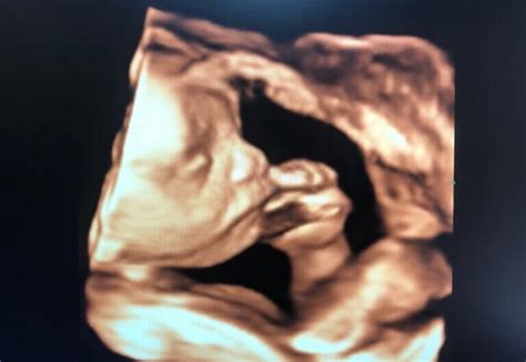 Ecografie fetală a unui făt la 12 săptămâni de sarcină, evidențiind translucența nucală.