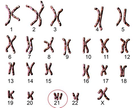 Ilustrație a cromozomilor, evidențiind trisomia 21 (sindrom Down).