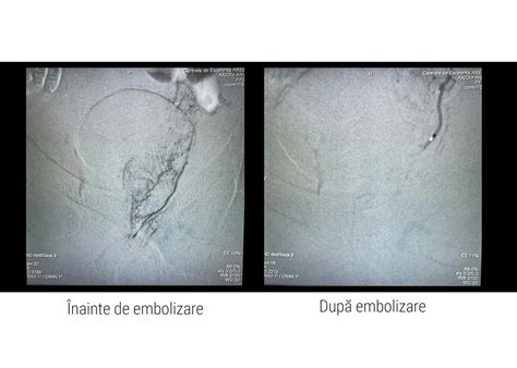 Ilustrație schematică a procedurii de embolizare a arterelor prostatice, arătând cateterul și microparticulele injectate.
