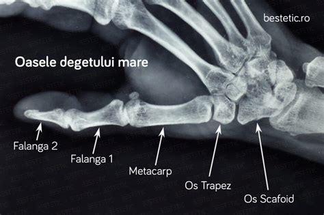 Radiografie cu oasele antebrațului fracturat, arătând o poziționare incorectă