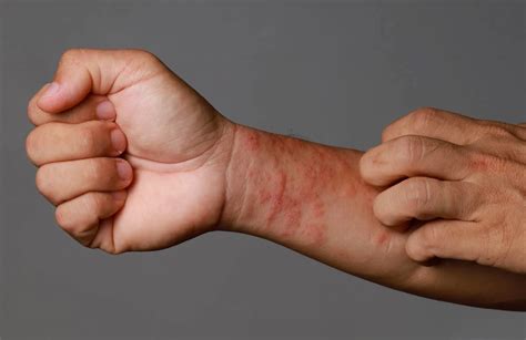 imagini comparative ale diferitelor tipuri de erupții cutanate la nou-născuți