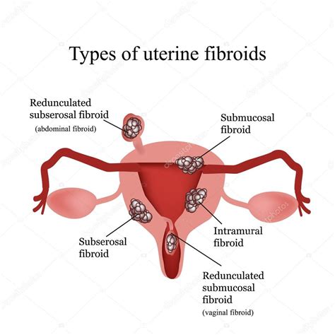 Ilustrație a diferitelor tipuri de incizii uterine.