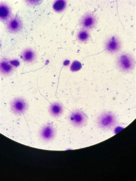 microscopie cu spermatozoizi cu și fără halo, reprezentând fragmentarea ADN-ului