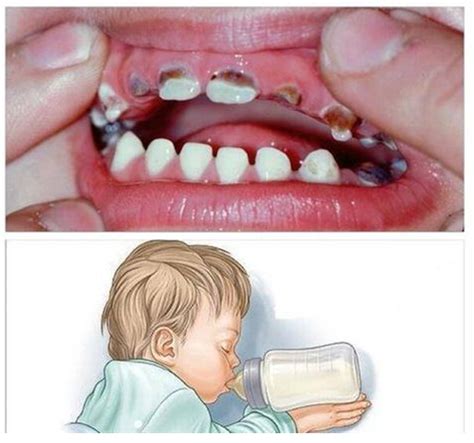Ilustrație schematică a unui dinte de lapte afectat de caria de biberon, cu zone de demineralizare și cavități.