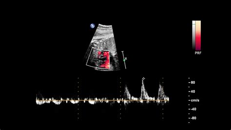 Ecografie fetală arătând o imagine clară a fătului în uter