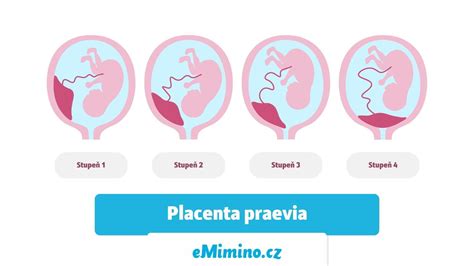 Diagramă comparativă a diferitelor tipuri de placenta praevia (marginală, parțială, completă)