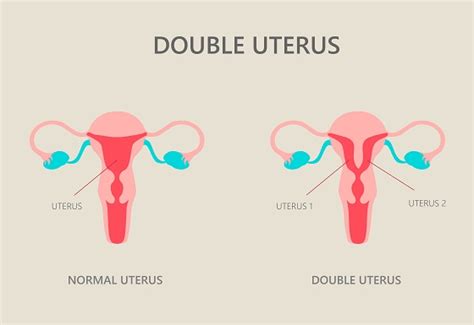 Ilustrație anatomică comparând un uter normal cu un uter didelf.