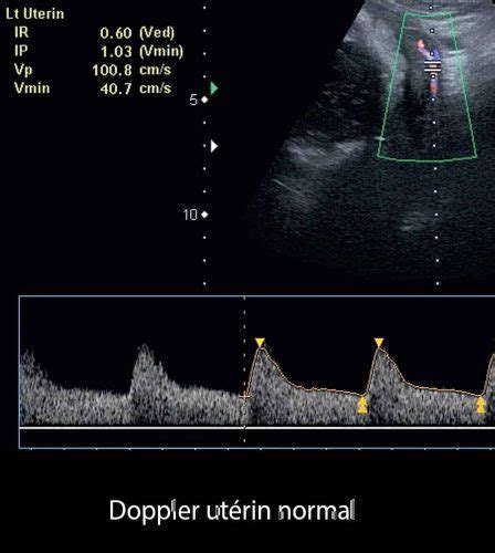 ecografie Doppler artere uterine
